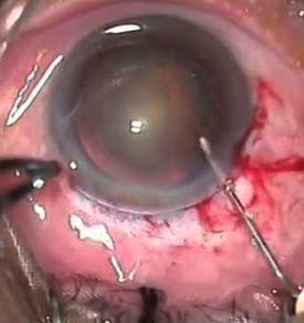 Extra-Capsular Cataract Extraction.