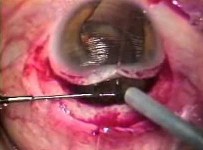Intra-Capsular Cataract Extraction.