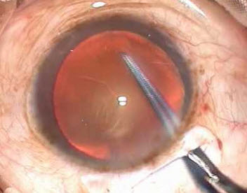 manual-small-incision-cataract-surgery