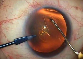 capsulorhexis