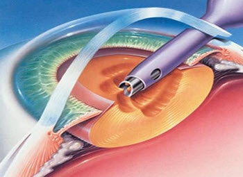 Phacoemulsifiering